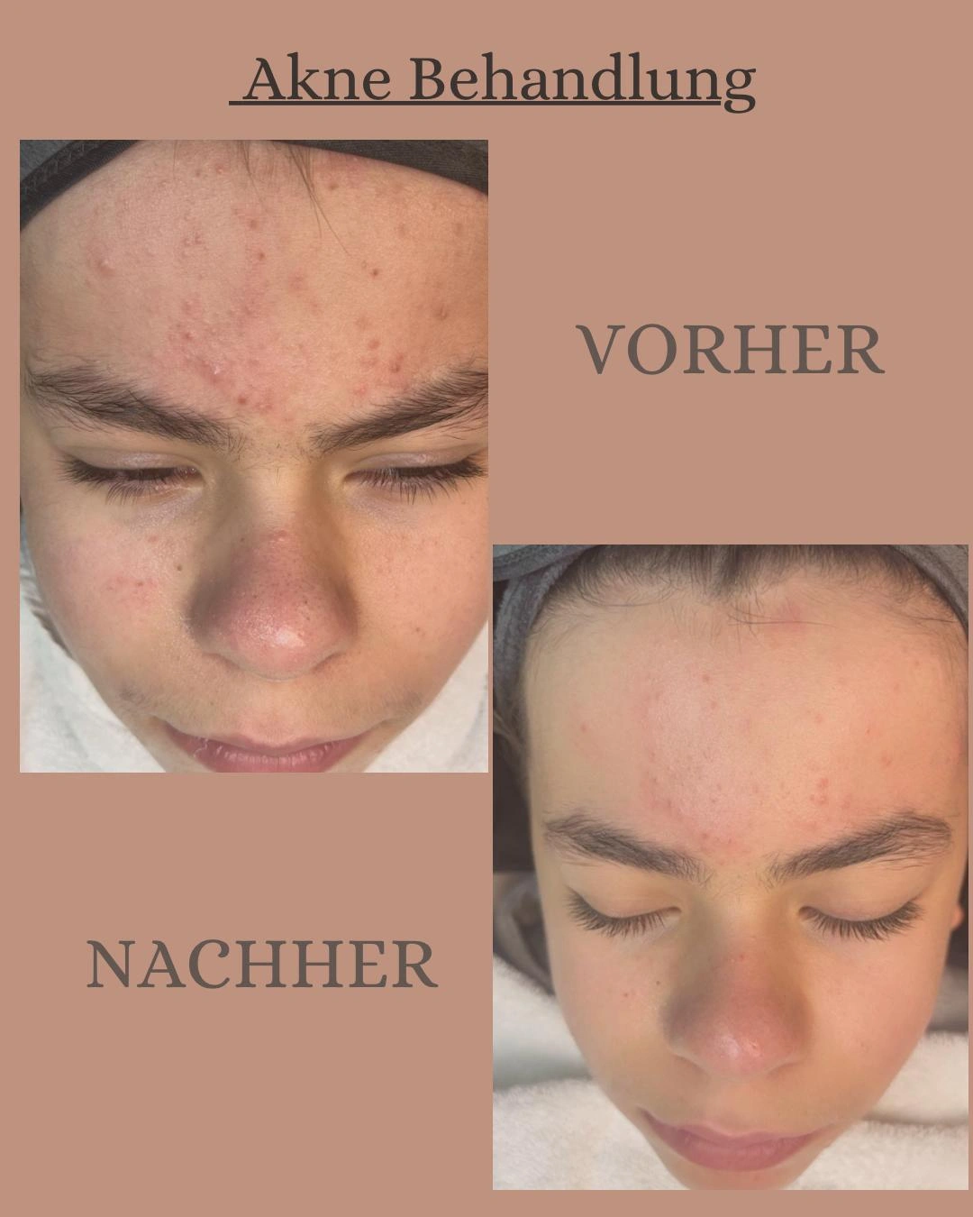 Vorher-nachher Ergebnis nach einer Fruchtsäurebehandlung und Tiefenreinigung im Studio Ginié in Heidelberg bei unreiner Haut