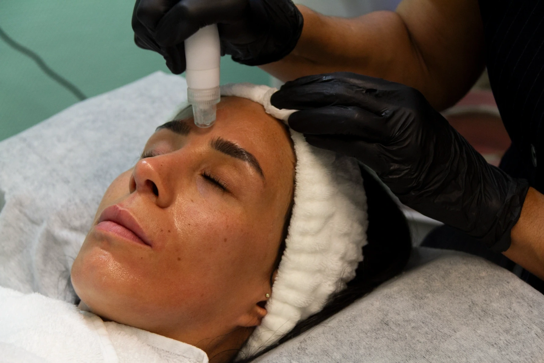 Needling mit Hyaluron Behandlung im Kosmetikstudio Ginie in Heidelberg.