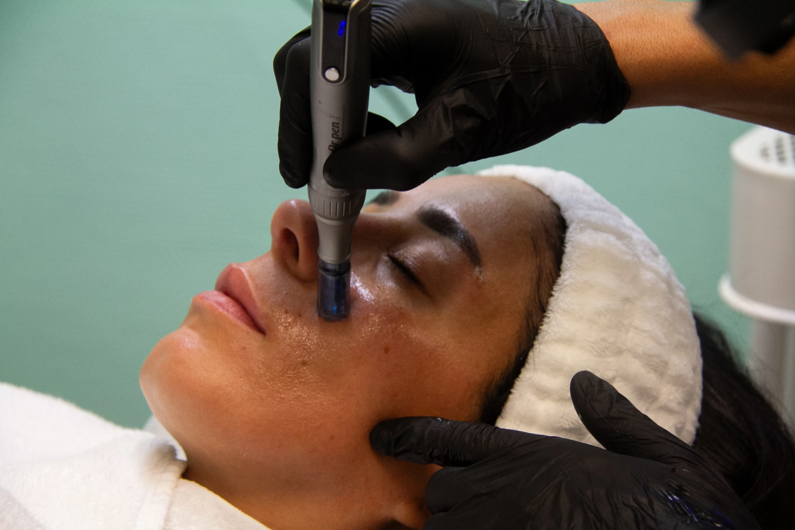 Needling mit Hyaluron Behandlung im Kosmetikstudio Ginie in Heidelberg.